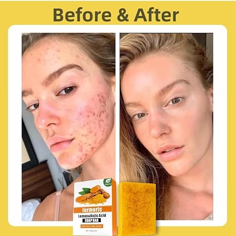 Kojic Acid & Turmeric Brightening Soap – Dark Spot Remover with Vitamin C, Retinol & Lemon Oil