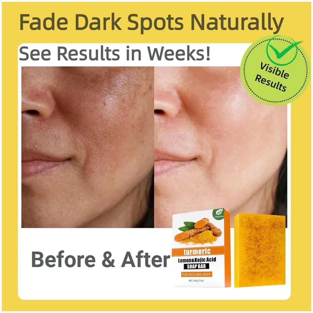 Kojic Acid & Turmeric Brightening Soap – Dark Spot Remover with Vitamin C, Retinol & Lemon Oil